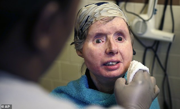 Charla Nash, 62, had a face transplant in 2011 after being viciously attacked by a chimpanzee