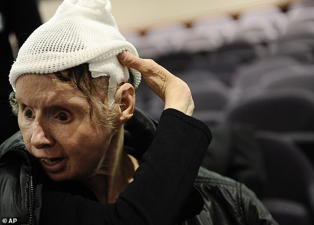 Nash lost her nose, lips, eyelids and hands when she was mauled in 2009 by her employer's 200-pound pet chimpanzee in Connecticut