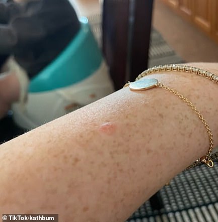 She explained that she had paid £300 for a seven-minute consultation with a doctor, who wrongly informed her the mole wasn't cancerous (Katherine's mole is pictured before her surgery)