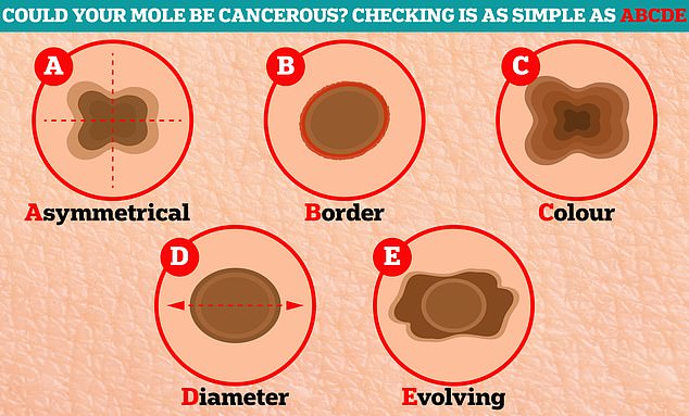 MailOnline reveals the simple ABCDE checklist that doctors use to spot melanomas