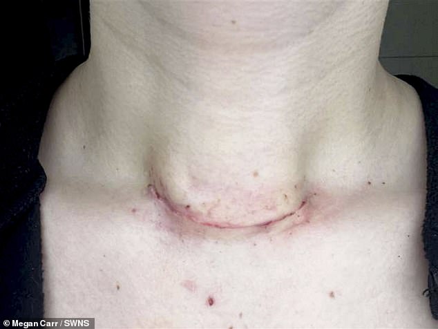 Megan Carr's neck a week after her second surger