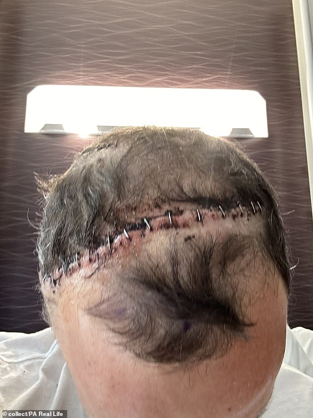 Mr Wade underwent five surgeries in total to treat the tumours