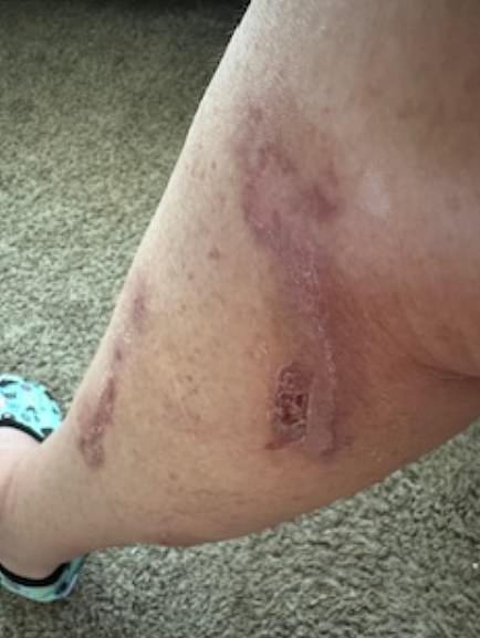 Robin Patrick has shared horrific pictures claiming that she was badly burned when she tried Meghan's recipe