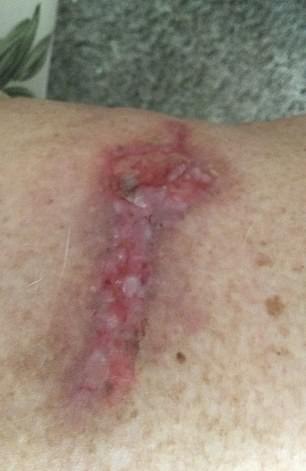 Robin claims that she suffered 18 burns and they are still not fully healed, leaving her vulnerable to infection