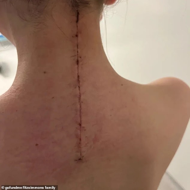 Doctors had to remove Holly's vertebrae and cut through her spinal column to remove the tumour, with a warning to the parents that it could be 'touch and go'