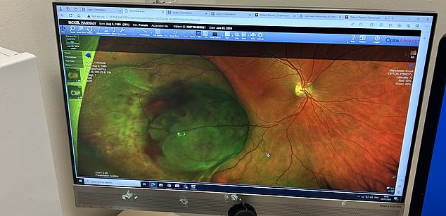 An image of Hannah's detached retina behind her right eye
