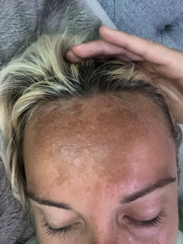 Close-up of a woman's forehead showing dark marks from nasal tanning spray.