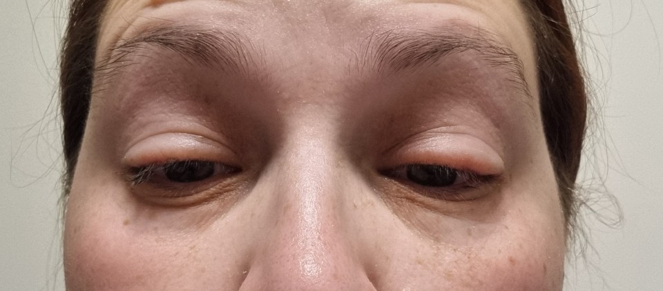 Close-up of a woman's face showing swollen eyes, possibly due to an allergic reaction.