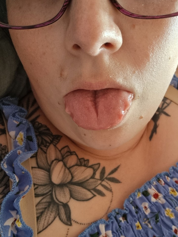 Close-up of a woman's swollen tongue after an allergic reaction to balloons.