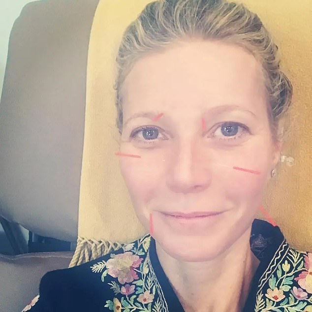 The practice, known as facial acupuncture, is touted as a 'natural Botox '¿and, naturally, Gwyneth Paltrow is said to be fans.