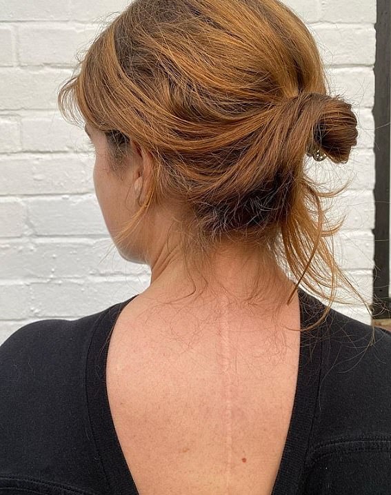 In a rare, wide-ranging interview, the royal mother-of-two, 34, also discussed how her Sarah Ferguson raised her to be proud of her scar (pictured) after she went underwent surgery at the age of 12