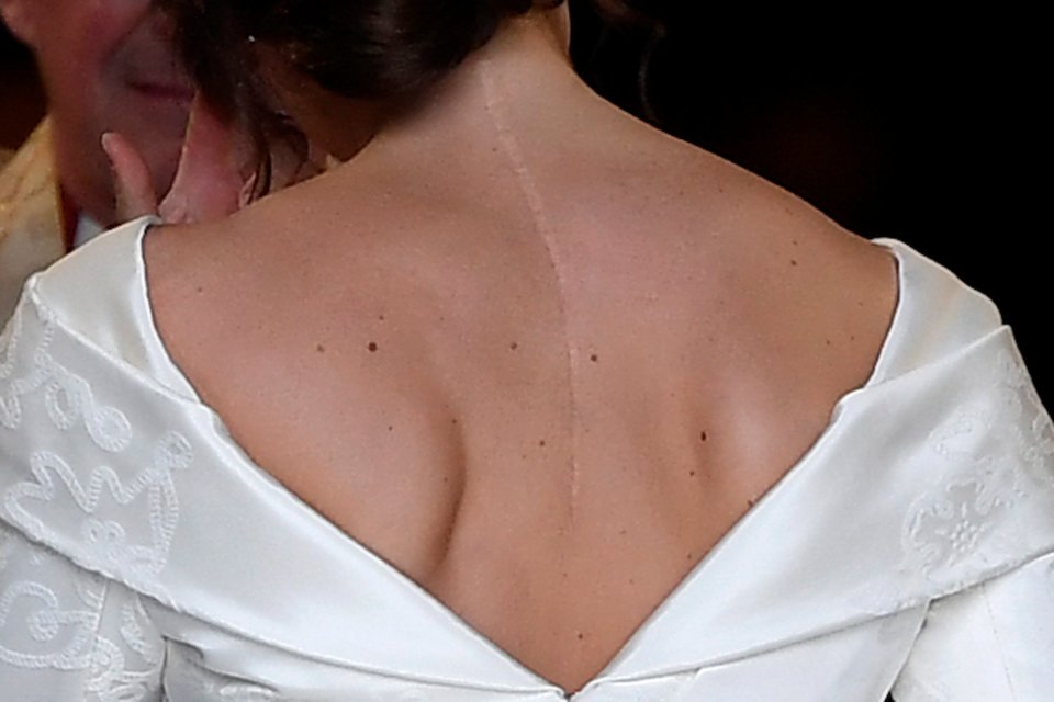 Princess Eugenie's back in her wedding dress, showing a spinal scar.