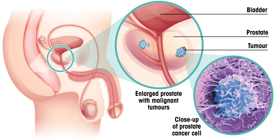 Illustration of enlarged prostate with malignant tumors, close-up of prostate cancer cell.