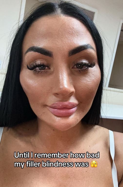 Close-up selfie of a woman with noticeable facial fillers, captioned "Until I remember how bad my filler blindness was."