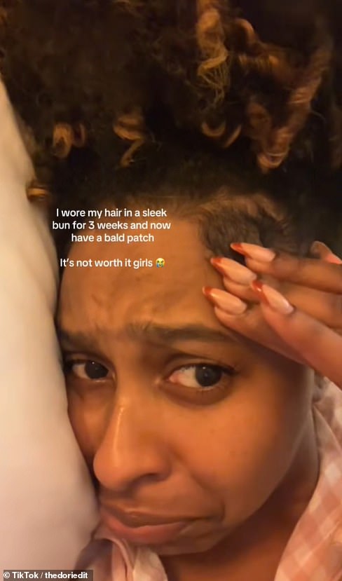 Dori, from London, said she wore her hair in a slicked back bun for three weeks in a row and noticed that she had a bald patch on her head