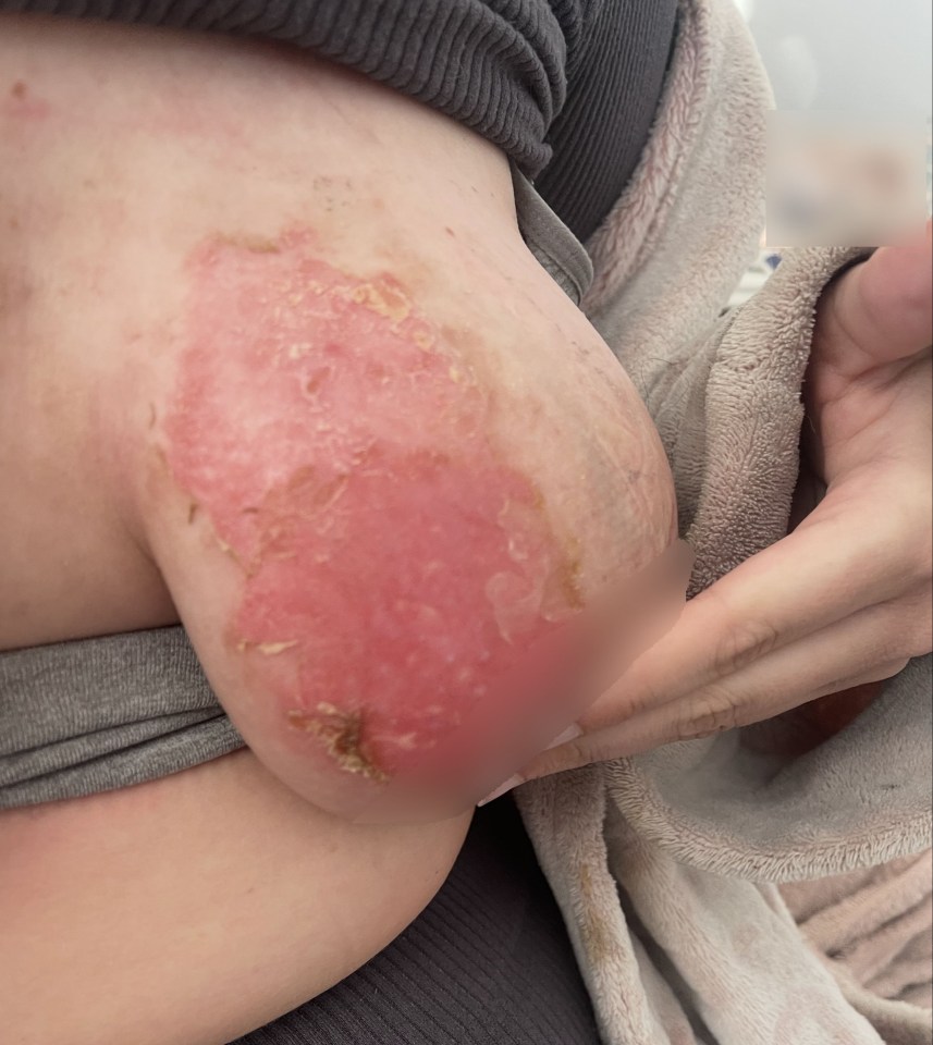Burn on a woman's breast from a scalding baby bottle.