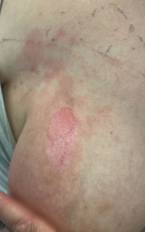 Close-up of a burn on a person's chest.