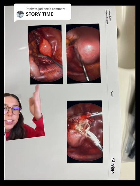 The video in which Savannah showed the cyst (pictured) went viral overnight
