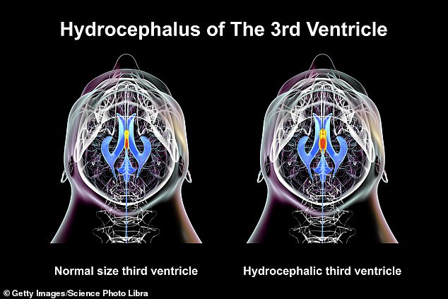 In normal pressure hydrocephalus, fluid collects in the ventricles in the brain - or the spaces in the brain - exerting more pressure. The condition, however, does not cause an uptick in brain pressure
