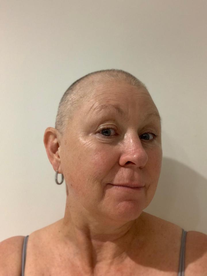 Woman with shaved head after her first chemotherapy session.