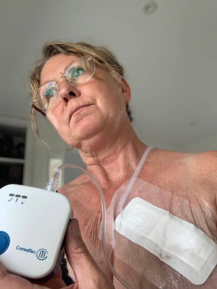 Woman with a medical device attached to her chest.