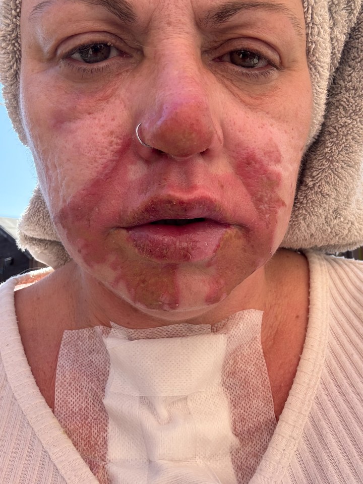 Close-up of a woman's face and chest showing second-degree burns.
