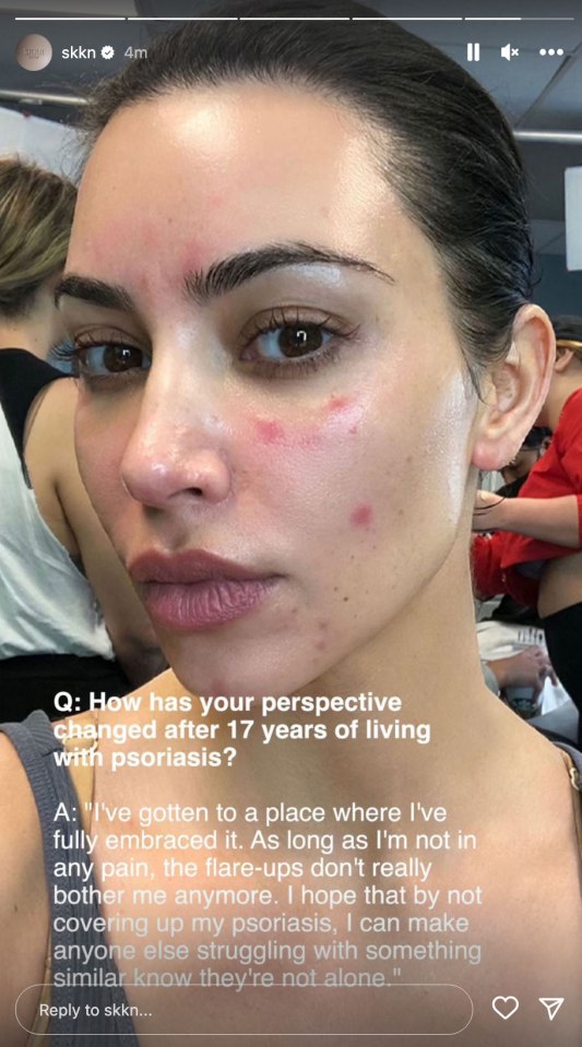 Close-up of Kim Kardashian's face showing psoriasis.
