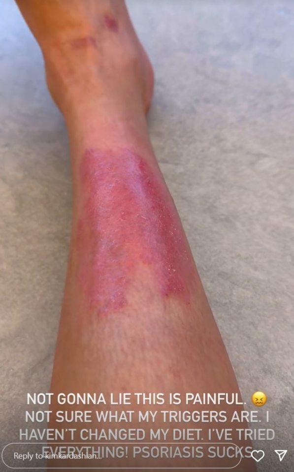 Image of a leg with psoriasis.