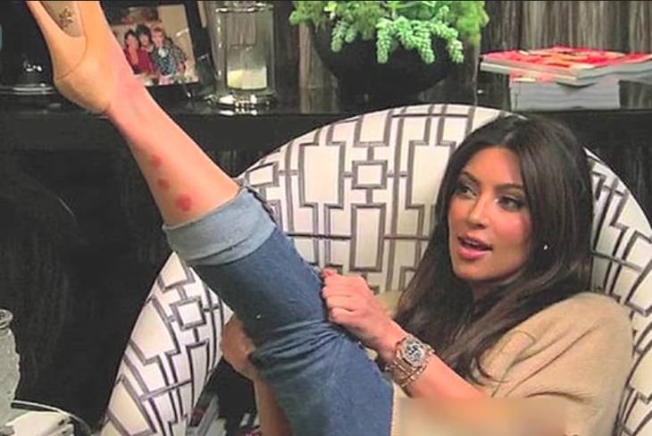Kim Kardashian showing psoriasis on her leg.