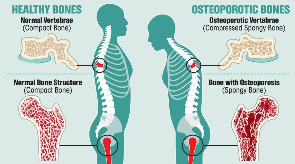 Illustration comparing healthy and osteoporotic bones, showing vertebrae and hip bone structures.