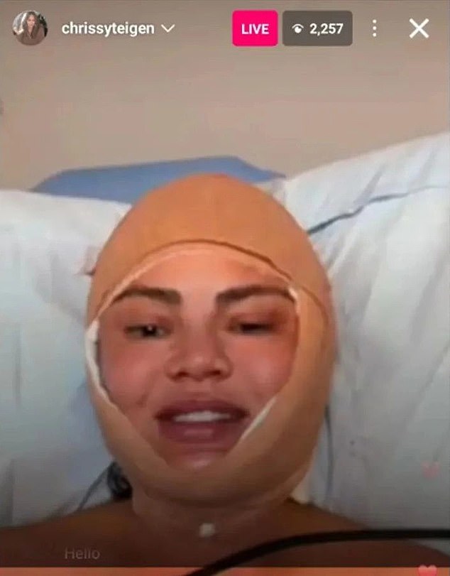 Plastic surgery lover Chrissy Teigen went under the knife and posted her mummified self in a massive head bandage on Instagram Live. Did she get a chin tuck? Does she have the mumps?