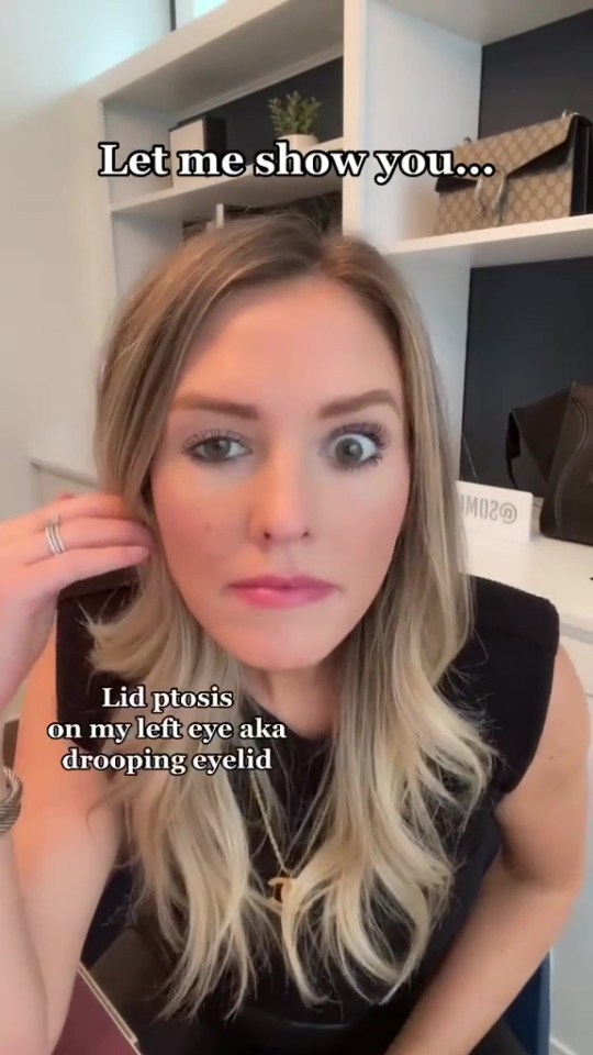 Woman showing her drooping eyelid from a botched Botox injection.