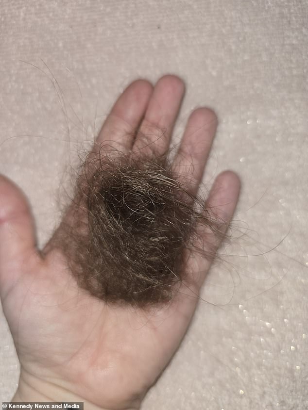 The hair loss was said to be the result of a vitamin B12 deficiency, which has previously been linked to extreme weight loss over short periods of time