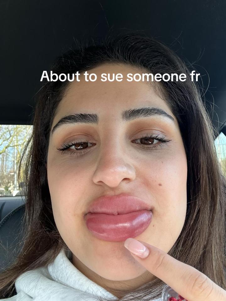 Close-up of a person's swollen lips; text overlay reads "About to sue someone fr".
