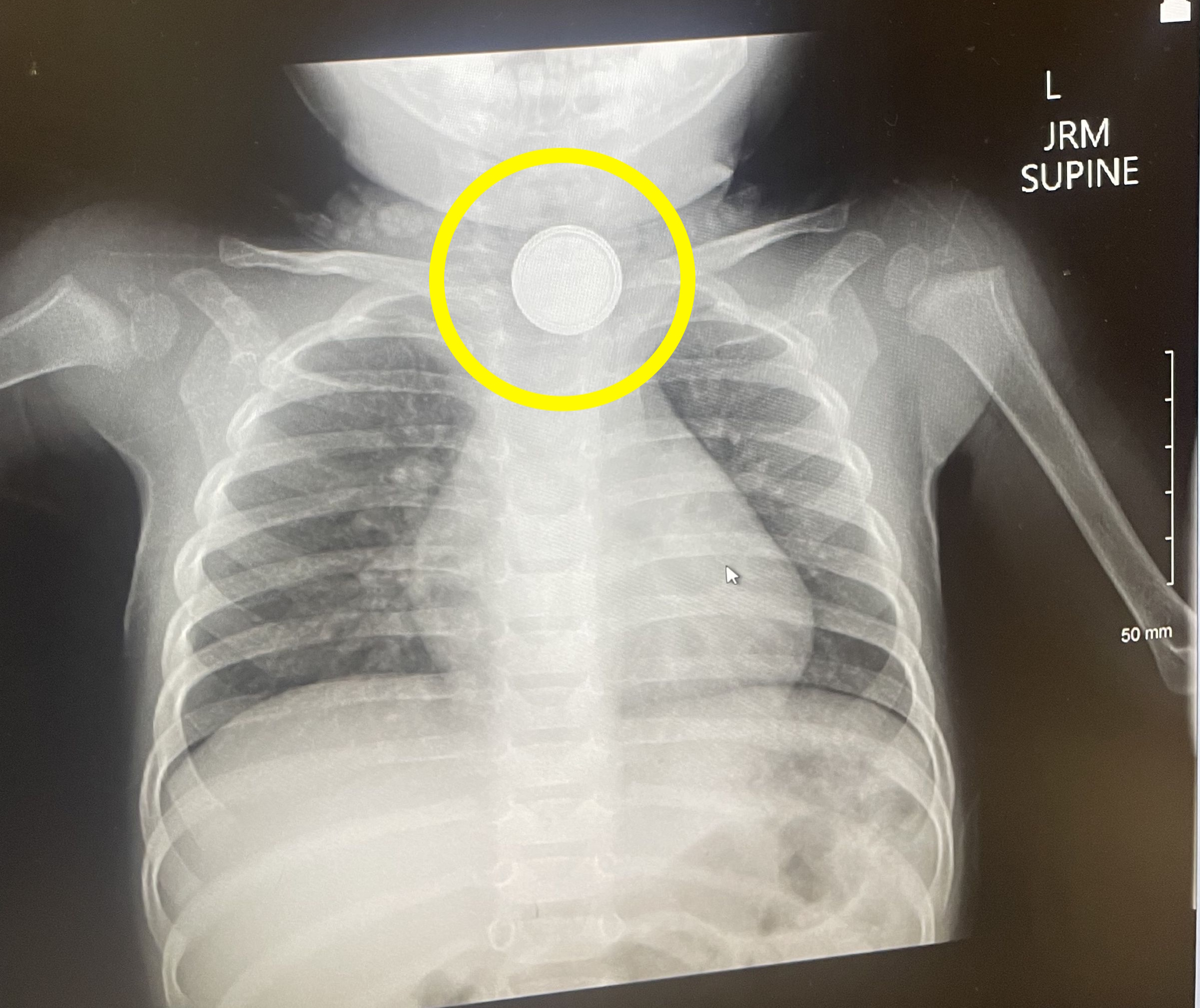 X-ray showing a button battery lodged in a child's throat.