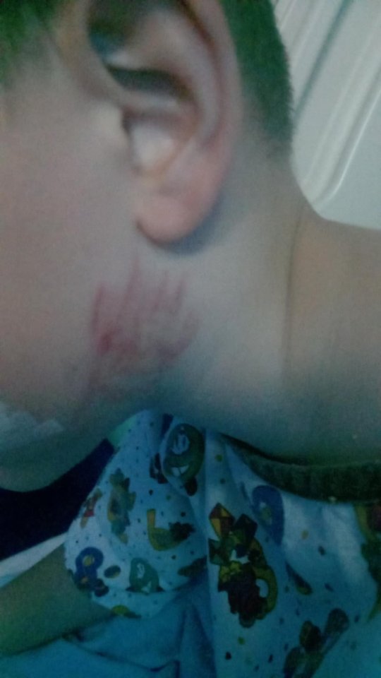 Photo of a child's neck with injuries from a dog attack.