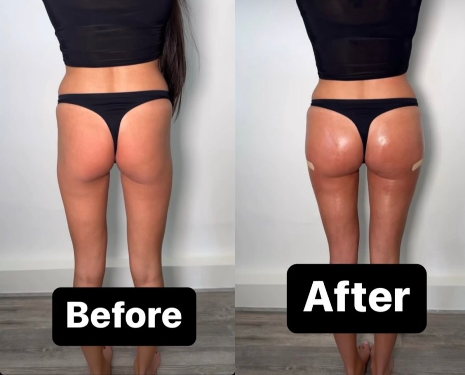 Before and after photos of a person's buttocks after a liquid BBL.