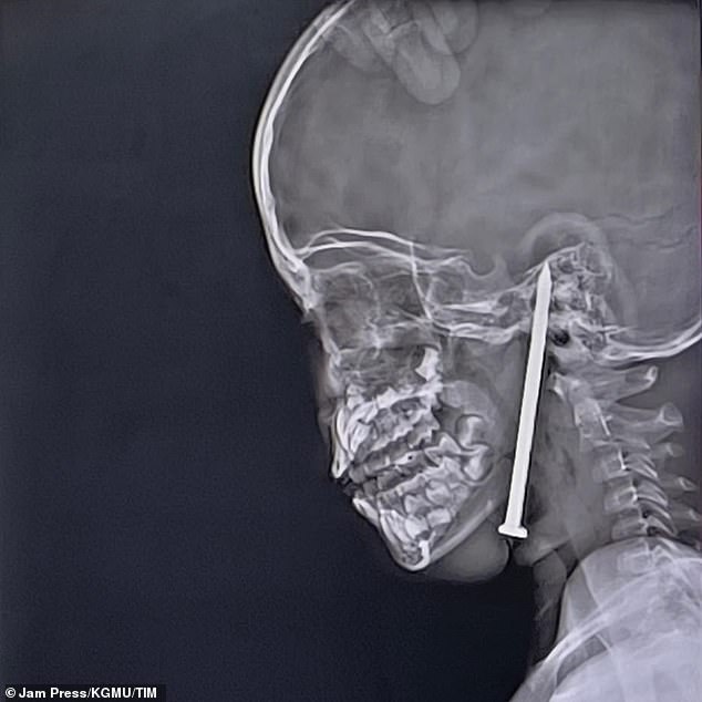Using advanced microsurgical techniques and neuro-navigation technology, surgeons at King George's Medical University worked tirelessly for 10 hours to remove the nail, managing to complete the extraction without damaging any critical blood vessels