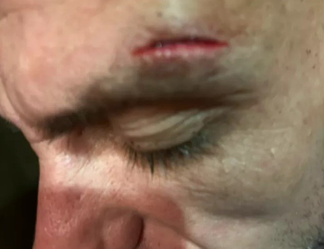 Close-up of a man's forehead showing a cut.