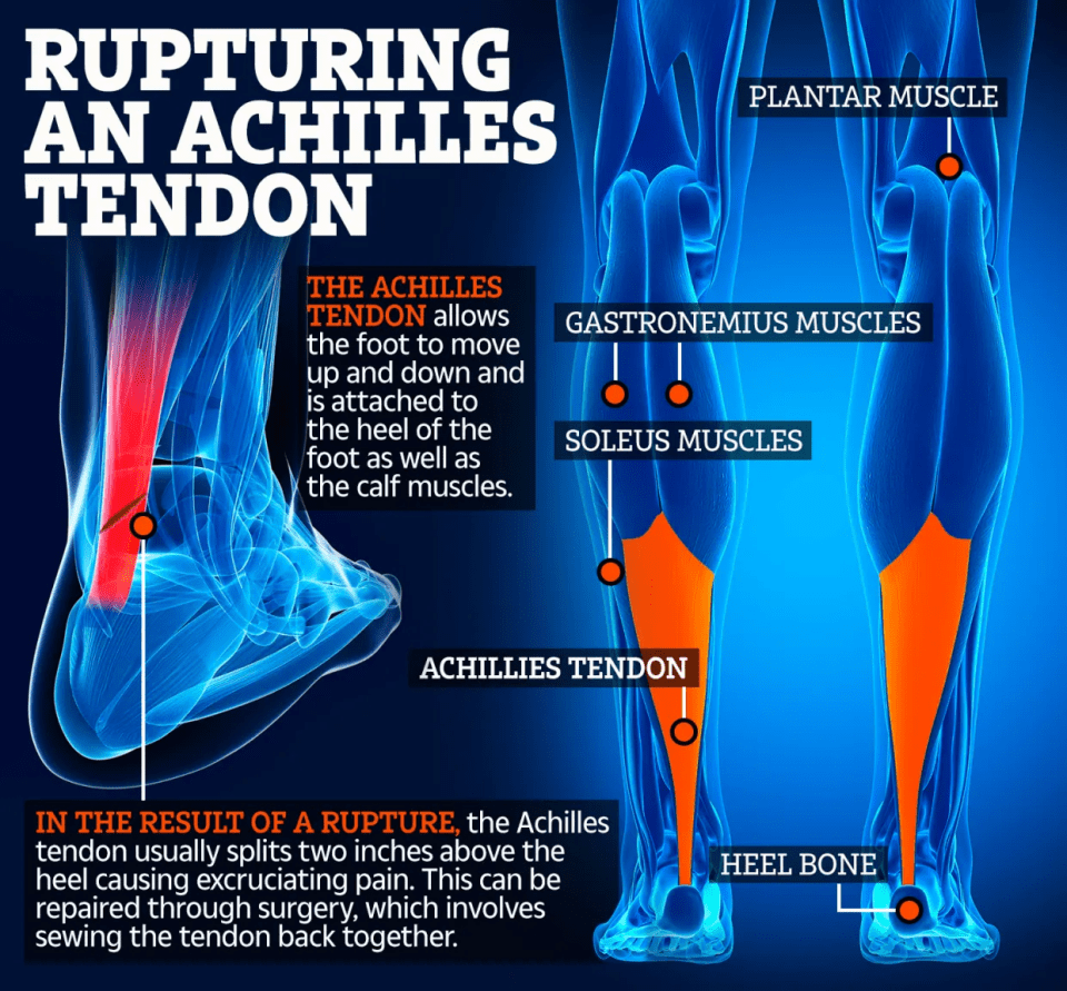 Illustration of a ruptured Achilles tendon and the surrounding muscles.