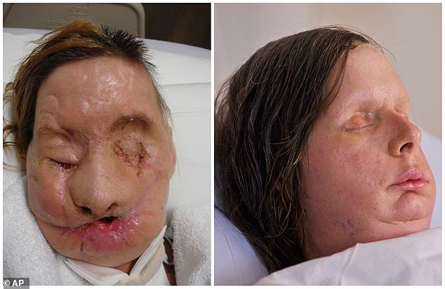 A 57-year-old woman from Connecticut. had to have a face transplant (right) after she was savagely mauled by a chimpanzee