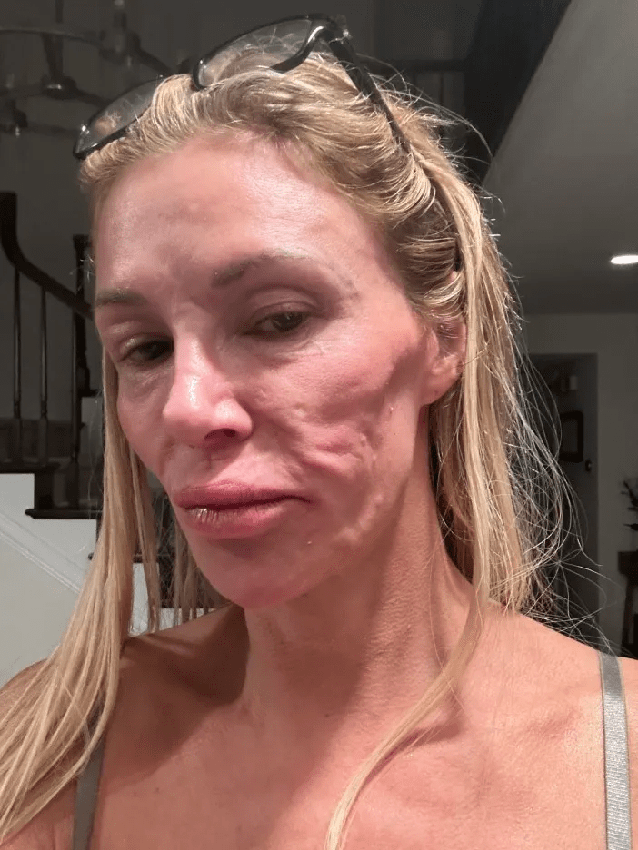 Brandi Glanville with a swollen face.