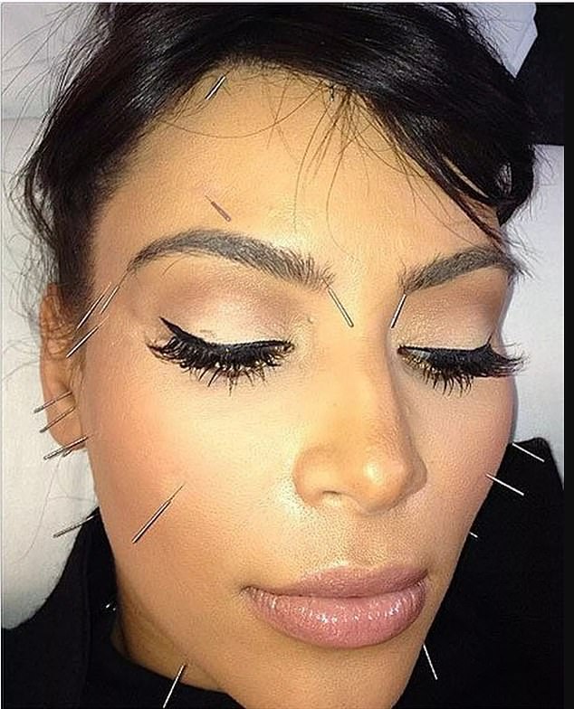It might sound like torture¿but having needles stuck into your cheeks, chin and forehead is an A-list secret to younger, glowing skin. Kim Kardashian posted images on social media having the treatment, above