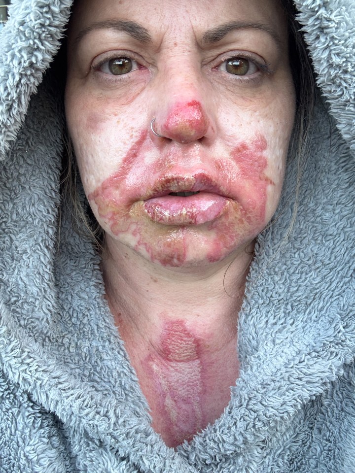 Close-up of a woman's face and chest showing second-degree burns.