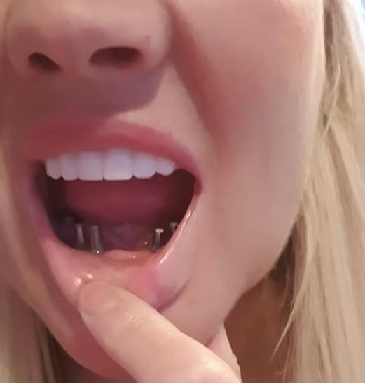 Leanne was initially happy with her temporary implants, but things soon took a turn for the worse when they started falling out just one month later
