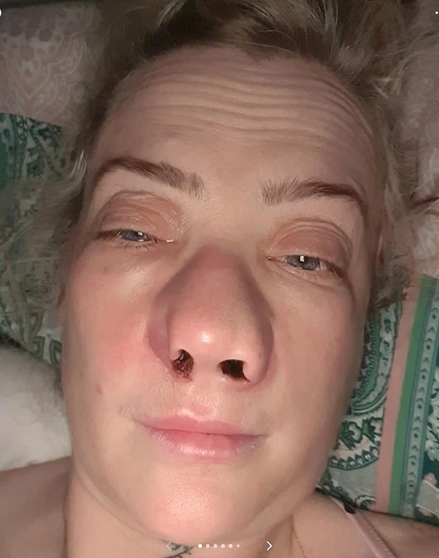 Leanne posted this photo to TikTok, taken earlier this month, to show the extent of the damage that has left her with excruciating pain, nose bleeds, headaches, blisters and swelling