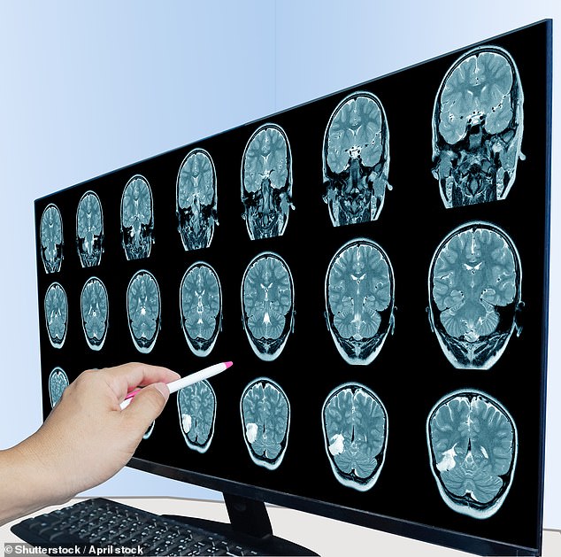 In a groundbreaking study, researchers analyzed brain tissue from 28 autopsies in 2016 and 26 in 2024, discovering that every sample contained microplastics, equivalent in mass to an entire plastic spoon
