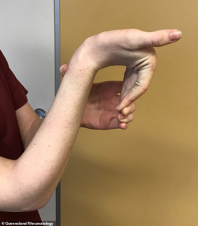 The connective tissue is 'the glue' of the body and when weakened, allows a person to bend their fingers or palm beyond a normal range of motion