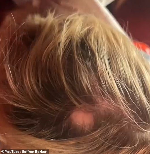 After wearing her hair in a tight bun, Saffron said she was in pain and then got a bald patch where the bun was