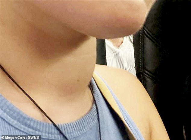 A young woman who thought a lump on her neck was a reaction to swimming in the sea was 'shocked' to instead be diagnosed with a rare cancer
